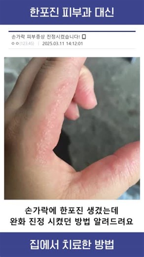한포진 피부과 대신 집에서 치료한 방법 #한포진 #한포진증상 #한포진치료