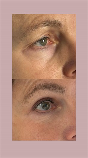 🇫🇷AVANT/APRES : résultat d’une mullerectomie pour remonter la paupière et traiter le ptosis combinée avec une résection de l’excédent de peau, un retrait des poches, et des injections de graisse pour un rendu des plus naturels. 🇺🇸BEFORE/AFTER: Results of a mullerectomy to lift the eyelid and treat ptosis, combined with removal of excess skin, removal of bags under the eyes, and fat injections for a more natural look. #beforeandafter #drhayot #drbeauregard #paupieres | Bernard Hayot