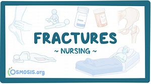 Case study - Hip fracture: Nursing: Video & Causes | Osmosis