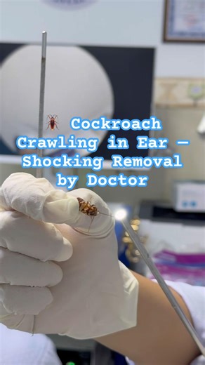 🪳 Cockroach Crawling in Ear — Shocking Removal by Doctor #earcare #medical #shorts