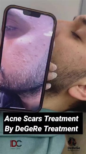 Dr Mahmood Khan|Mumbai|Delhi|Bhopal on Instagram: "Successful Results Of Acne Scars By DeGeRe Treatment : DeGeRe is a treatment of customized therapies, which is specially customized as per patient skin scars. Conditions are needed. Skin regeneration is the process of replacing old skin cells with new ones. It’s a continuous cycle that helps maintain healthy skin, which proper guidance for patient skin needed. DeGeRe is a treatment developed to rebuild and restructure the skin that as lost tissu