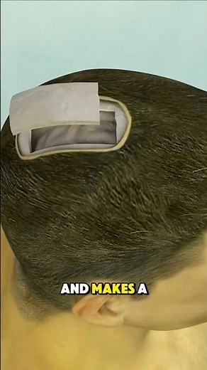 Brain tumor Removal surgery: Craniotomy (3d animation) #brainsurgery #tumortreatment