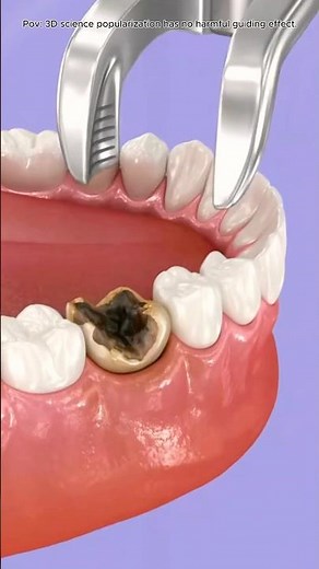 Tooth Extraction Procedure Explained Step-by-Step#doctor #3d #Tooth#Takeoutatooth#3Dsurgery