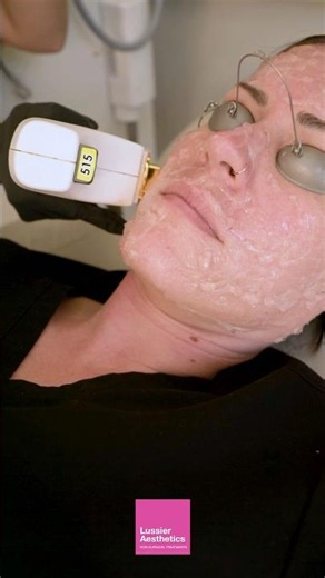 BBL Laser for Brown Spots and Sun Damage #skinhealth #skinglow