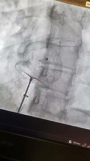 Atrial Septal Defect (Hole in heart) Closure via key hole, without Open Heart surgery. Dr Binoy John