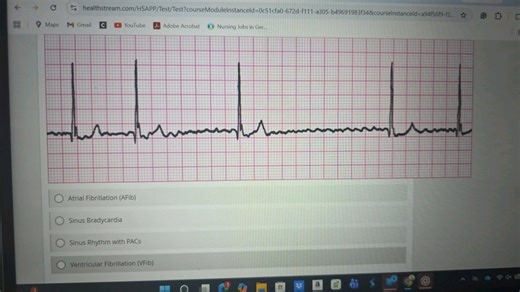 What does the given ECG graph represent?  Atrial Fibrillation (... | Filo