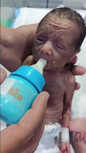 Preterm Baby Nutritional Support | Bottle Feeding in the NICU #neonatologist