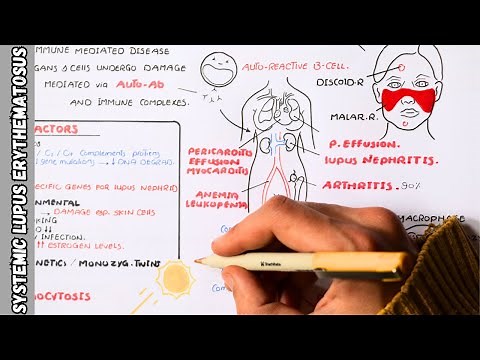 Systemic Lupus Erythematosus (SLE) _ signs and symptoms, pathophysiology, investigations, treatment
