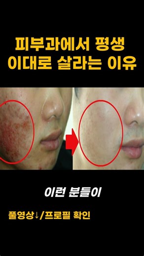 The process of starting with folliculitis and receiving a diagnosis for seborrheic dermatitis and...