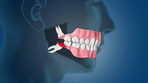 Stay wise when dealing with your wisdom teeth. Connect with an oral and maxillofacial surgeon today about managing your wisdom teeth. | American Association of Oral and Maxillofacial Surgeons - AAOMS