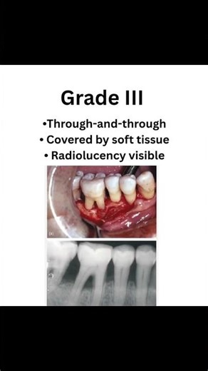 Furcation involvement#dentist#dentessa#dentalartistry#dentalcare#dentalclinic#dentalhealth#ytshorts