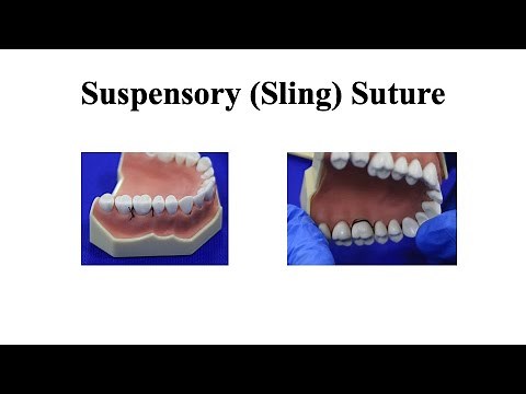 Suspensory Sling Suture