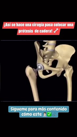 ¡ASÍ se HACE una COLOCACIÓN de PRÓTESIS de CADERA! #viralshort #viral #medicine #parati #salud