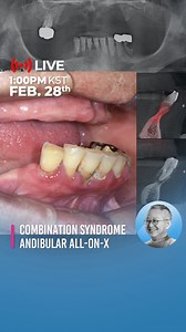 Combination Syndrome ⎪ Mandibular All-On-X what surgical methods might be available?🤔 Please consider and join us the live surgery. YouTube ▶️Dr. Park's Implant Surgery Room Find out the channel linked in the bio! #labial #Undercut #full_mouth #All_On_5 #BoneLoss #MegaGen #MegaGenImplant #AnyRidge #BlueDiamond #ARi #LiveSurgery #Dentistry #DentalImplant #박광범 #Dr_Park | MegaGen Implant