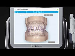 iTero Scanner Tutorial Invisalign Outcome Simulator