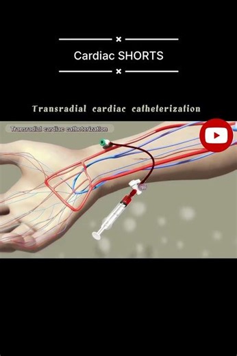 Transradial Cardiac Catheterization | Heart Animation #shorts #youtubeshorts