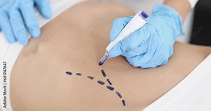 Plastic surgeon drawing preoperative markings on patient abdomen closeup 4k movie slow motion. Plastic surgery and aesthetic medicine liposuction concept