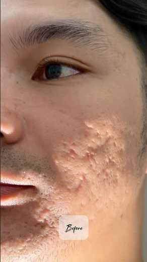 Acne Scars Before and After Subcision with RF Microneedling #acnescars #acnescarstreatment #rfmn