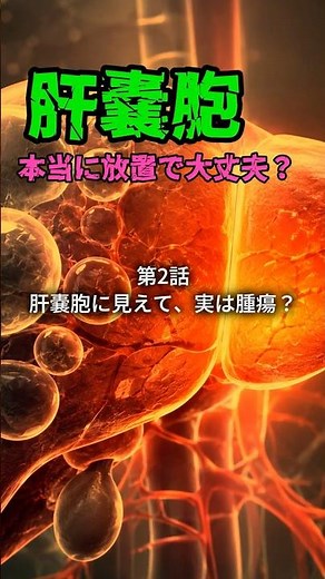 肝嚢胞、本当に放置で大丈夫？② 肝嚢胞に見えて、実は腫瘍？ #肝嚢胞 #肝臓 #肝臓専門医 #MCN #IPNB #腹部エコー #肝臓病 #shorts