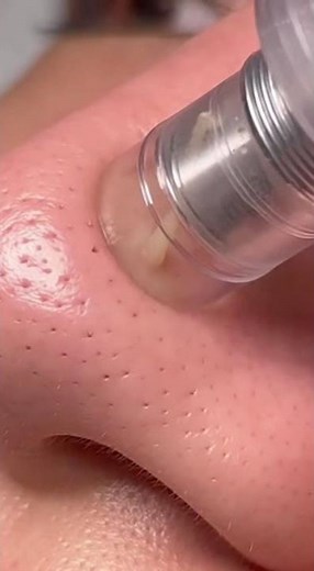 Pore Vacuum Blackhead Removal: Deep Clean Clogged Pores on Nose