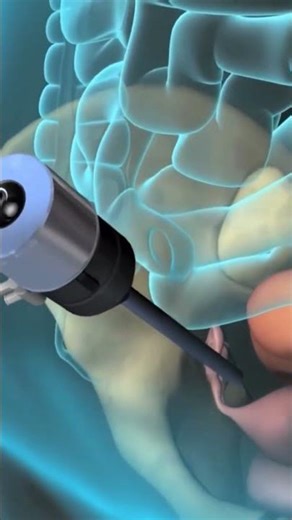 "Regain Your Health with Laparoscopic Myomectomy for Uterine Fibroids"