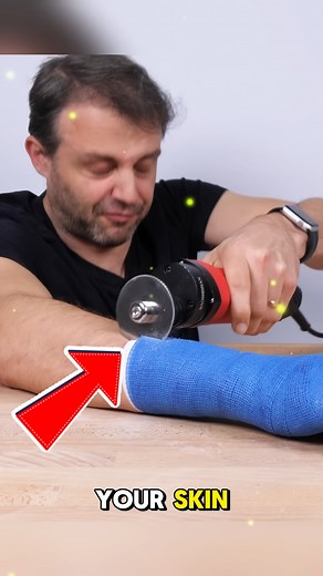 Why Cast Saws Are Safe for Skin — The Hidden Science Here’s the fascinating reason cast saws can’t cut skin — they use vibration, not rotation, to safely remove casts without injury. This smart medical innovation ensures patient safety while improving efficiency in hospitals and clinics worldwide. A true example of precision healthcare technology. Credits: @ zackdfilms /YT @ Steve Mould /YT @ TKOR /YT @ Experio-s9h #MedicalInnovation #HealthTech #Safety #Technology #technews | Tech Reels