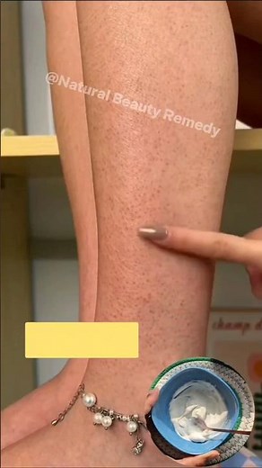 ✨ Remove dark spots on legs & hands naturally at home 🌿Get smooth, even-toned glowing skin #ytshorts