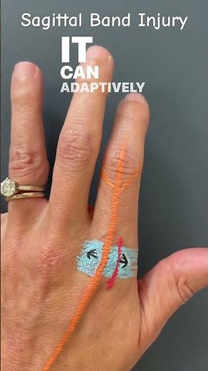 Sagittal Band Injury #chtexam #handtherapy #certifiedhandtherapist #handtherapist #chtexam