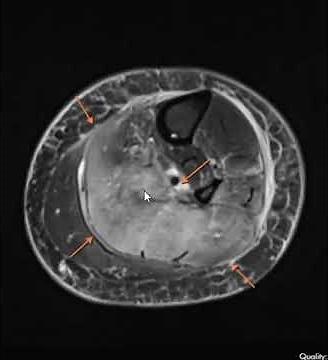 Compartment syndrome