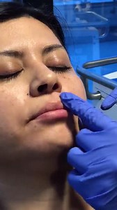 No-Needle Lip Lift With Volbella