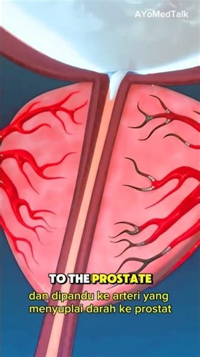 Embolisasi Arteri Prostat #prostat #artery #embolization #shrink #medis #medtalks #medicalanimation
