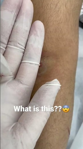 皮膚腫瘤切除 skin tumor excision