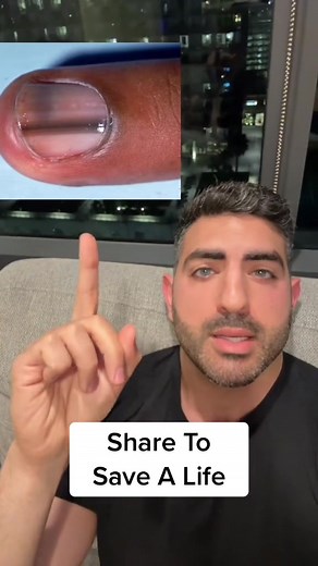 Nail Melanoma: Early Signs & Symptoms