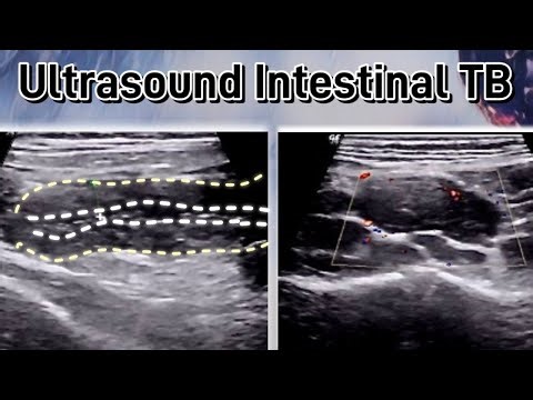 Ultrasound Intestinal Tuberculosis TB