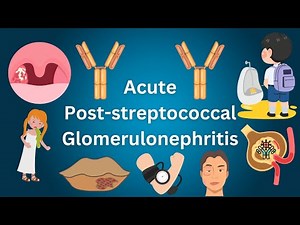 Acute Post-streptococcal Glomerulonephritis (PSGN) | Nephritic Syndrome | USMLE Course