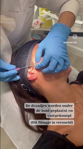 Threadlift Procedure Before & After