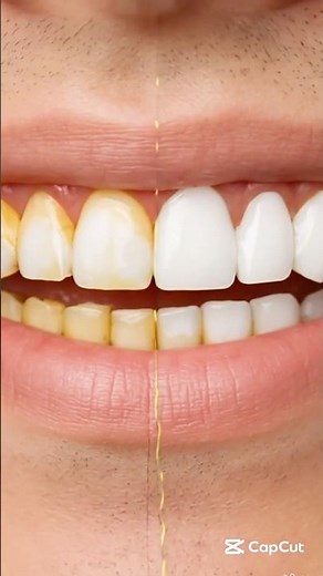 “Whiten Yellow Teeth in 2 Minutes | Remove Tartar Instantly | Banana Peel Hack”