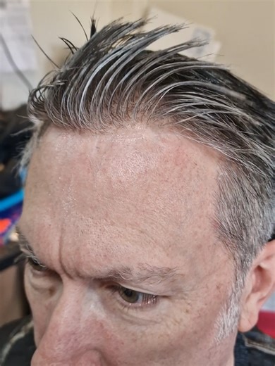 Hair Replacement Journey: Dave's System After 6 Months