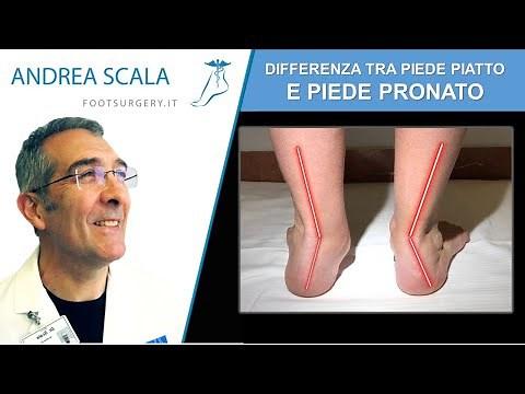 Piede piatto o piede pronato | Come riconoscere il piede pronato | Piede pronato bilaterale
