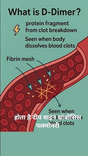 🩸 D-Dimer Test Explained | Blood Clot Test | Medical Shorts