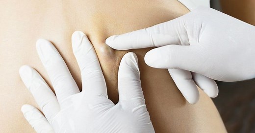 We In-cyst You Watch These 25 Pimple Popping Videos