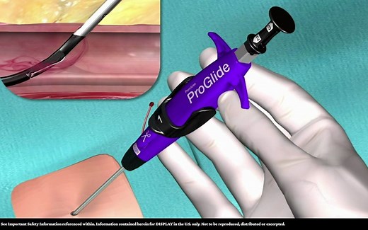 血管闭合装置系列：Perclose ProGlide动画演示，How to Perclose ProGlide Single Device Deployment