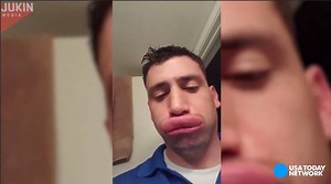 A man jokes he got 'free collagen lip injections' after he was stung by two yellow jackets. | USA TODAY