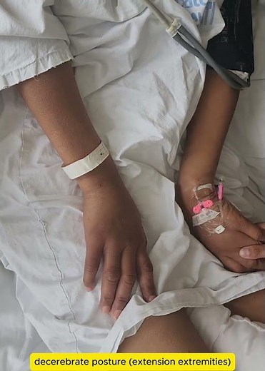 decerebrate posture - real case after brain injury