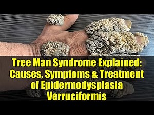 Tree Man Syndrome Explained: Causes, Symptoms & Treatment of Epidermodysplasia Verruciformis
