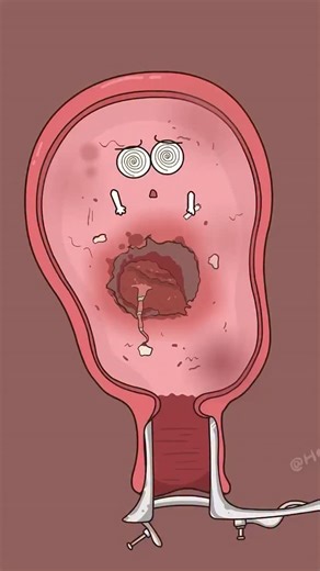 Health | Animation | Body | on Instagram: "Why is a D&C procedure so painful? Ever wondered why "cleaning the womb" is such a traumatic experience for the body? A Dilation and Curettage (D&C) is often a necessary medical procedure after a miscarriage or for certain uterine conditions, but it takes a massive toll on the endometrium (the uterine lining). Follow @healthmanazer11 for moree #HealthTips #WomensHealth #SurgeryRecovery #DandC #MedicalEducation"