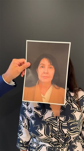 Adult Content | All plastic surgery is invasive and has risks. Recovery varies between 1-4 weeks. More information on our website. 59 at time of Facelift and now 60. This patient had a Deep Plane Face and Neck Lift, lateral brow lift, upper eyelid surgery, micro fat transfer and skin re surfacing. Surgery by Dr Jack Zoumaras Pictured live and thank you for sharing. Specialist Plastic Surgeon (MED0001196472) Results vary and are illustrated as a guide only. Any surgical or invasive procedure carr