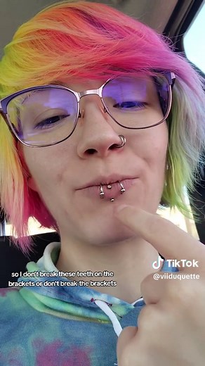 Braces Journey: My Experience with Adult Braces | Day One