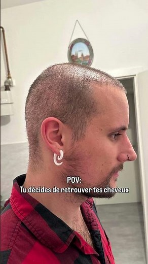 Avant/Après incroyable après une greffe de cheveux 🔥