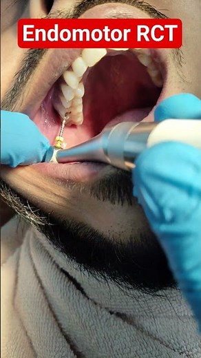 # Endomotor # Root Canal Treatment by Protaper # RCT by Rotary Instrument